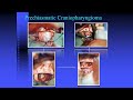 neurosurgery on the go craniopharyngioma – classification clinicopathology management