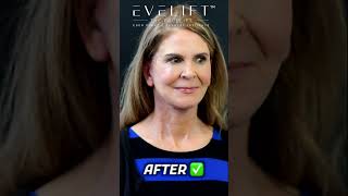 Countdown Before And After EVE Lift™ | Eden Plastic Surgery: Dr. Ali Charafeddine, MD