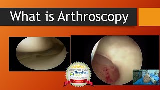 What is Arthroscopy