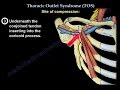 Thoracic Outlet Syndrome - Everything You Need To Know - Dr. Nabil Ebraheim