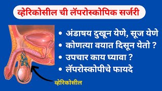 अंडाशयाचा गंभीर आजार व्हेरिकोसीलचा उपचार | Varicocele Treatment in Marathi