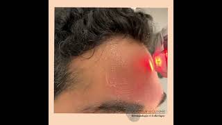 Dr. Molinari - Laser FRAXEL : traitement pour les rides