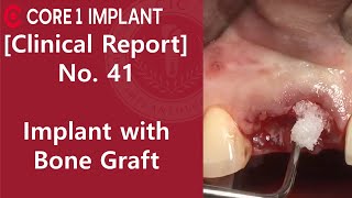 [CYBERMED Clinical Report] Implant on #11, 12 with bone graft