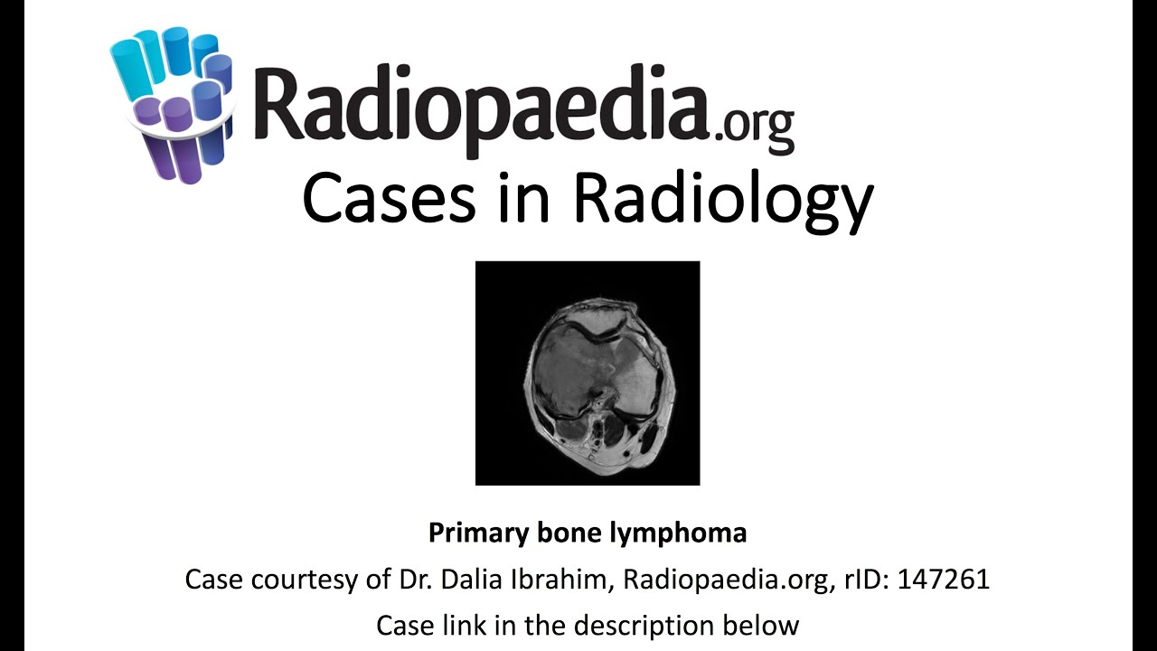 Primary Bone Lymphoma (Radiopaedia.org) Cases In Radiology - YouTube