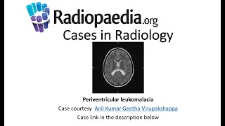 Periventricular leukomalacia (Radiopaedia.org) Cases in Radiology