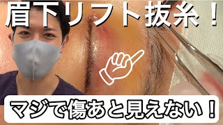 眉下リフト抜糸！抜糸が痛いってホント⁉︎ 湘南美容クリニック【眉下リフト】【目頭切開プレミアム】