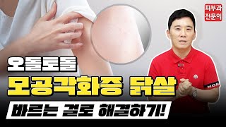 오돌토돌 모공각화증 닭살, 바르는 걸로 해결❗