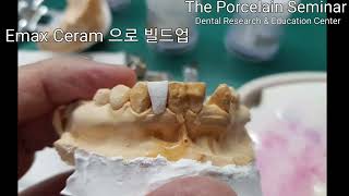 무삭제 메릴랜드 지르코니아 브릿지  Nonprep Maryland bridge Zirconia