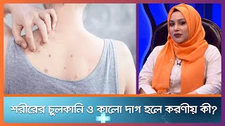 শরীরের বিভিন্ন জায়গায় চুলকানি ও কালো দাগ হলে করণীয় কী? ।। Health Tips ।। Nexus Television