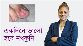 মাত্র ১ দিনেই পায়ের নখের ফাঙ্গাস দূর করার উপায়। নখের কুনি পাকা সমস্যা ১০০% সমাধান। নখের কুনি পাকা