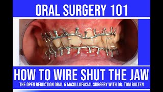 HOW TO WIRE SHUT THE JAW! | STEP by STEP LIVE INSTRUCTION | CLOSED REDUCTION wit