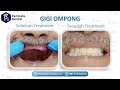 Pembuatan & Pemasangan Gigi Palsu Thermosen | Klinik Permata Dental