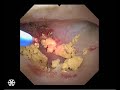 hugemed single use ureterorenoscope hu30 clinical video 1