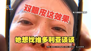 【1818黄金眼】“维多利亚”做的双眼皮，三年后心里还有“疙瘩”