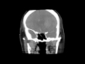 acute intracerebral haemorrhage 1