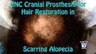 Scarring Alopecia Hair Restoration for Patient \