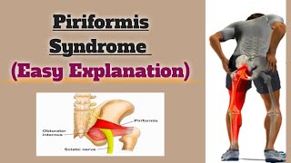 What causes piriformis syndrome? @easymedical4615