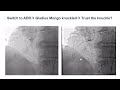 case 198 manual of cto pci it takes time...