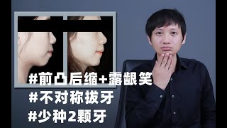 迎难而上！不对称拔牙逆旋送下巴！顺便省了种植钱！