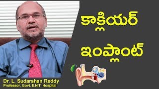 కాక్లియర్ ఇంప్లాంట్  | Cochlear Implant  | bellPeppers Media