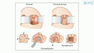 choanal atresia