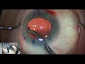 eugene eyecare live cataract surgery