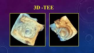 Severe AS and concomitant significant other valvular disease