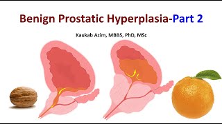 Benign Prostatic Hyperplasia  Part 2