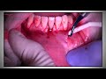 gingival augmentation tunnel technique 2 mucoderm dermis botiss by dr bernard dahan