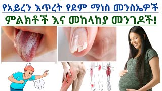 የአይረን እጥረት የደም ማነስ መንስኤዎች,ምልክቶች እና መከላከያ መፍትሄዎች| Iron deficiency anemia symptoms and causes