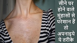 सीने पर होने वाले मुंहासों से परेशान हैं तो अपनाइये ये तरीके by Make Up