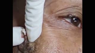 Blackheads Removal   Best Pimple Popping Videos #09