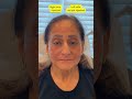 liquid facelift journey