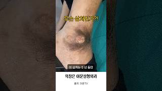 무슨 상처 인가?! (발목 욕창 소독 치료 병원 성형외과 ankle bedsore pressure sore dressing seoul korea)[아문TV]