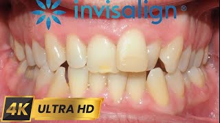 Лечение с #INVISALIGN за 10 месеца! #4k