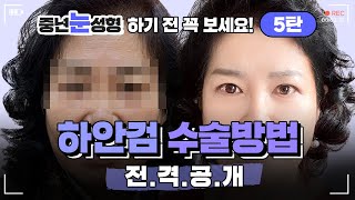 중년눈성형 전 필수 시청! 하안검수술 방법 전.격.공.개