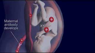 Jaundice: Hemolytic Disease \