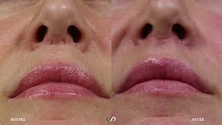 REVISION LIP LIFT | Before and After Video | Dr. David Stoker