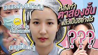 รีวิวทำตาสองชั้น แก้ปัญหาตาสองข้างไม่เท่ากัน มีชั้นตาซ้อน ตาดูง่วง !