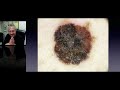 common benign lesions part 1 prof giuseppe argenziano