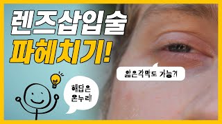 렌즈삽입술 파헤치기! (ICL장점/토릭ICL/토릭렌즈단점)