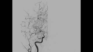 Moyamoya vasculopathy in a patient with new-onset coma