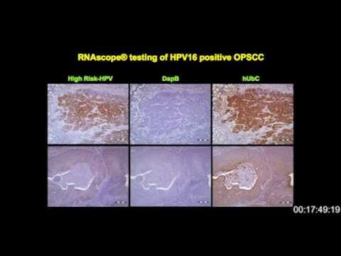 Neck Cancer surgery , Neck cancer symptoms Neck Cancer surgery , Neck cancer symptoms