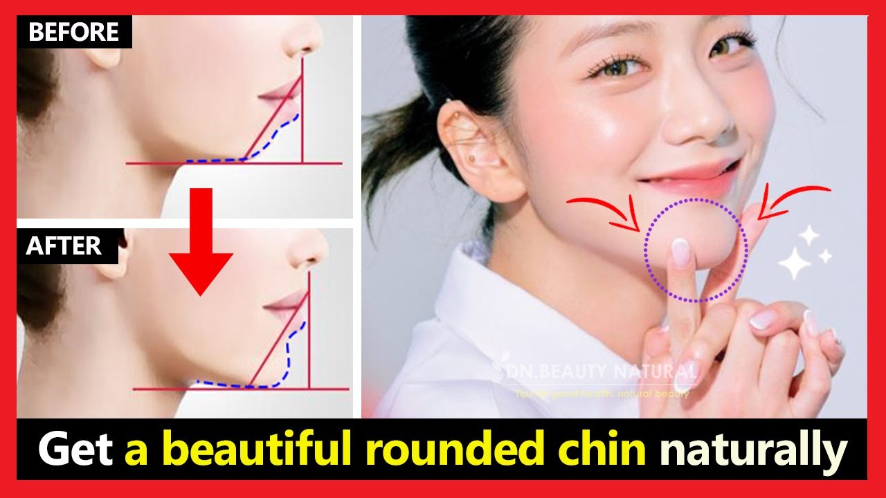 Chin Dimple Removal