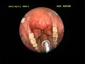 large lipoma in throat posterior pharyngeal wall