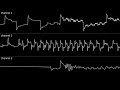 x1l3 ay 300 sanxion oscilloscope view