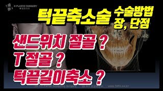 턱끝축소술 종류와 수술방법의 목적 및 장단점 (샌드위치절골, T절골, 턱끝길이축소) [에이치성형외과]