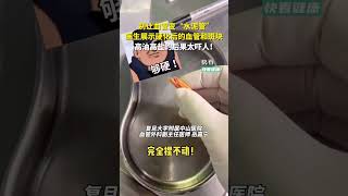 千万别让血管变“水泥管”，医生展示硬化后的血管和斑块，高油高盐的后果太吓人！