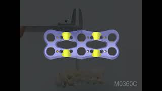 DepuySynthes (Synthes):  Vectra Cervical Plate