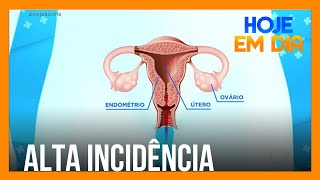 Doutor Sproesser explica como surge a endometriose